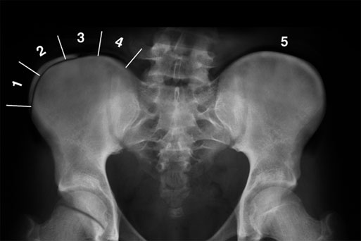 The ossification of the iliac apophysis creates the Risser sign (X-ray courtesy of John T. Killian, M.D.)